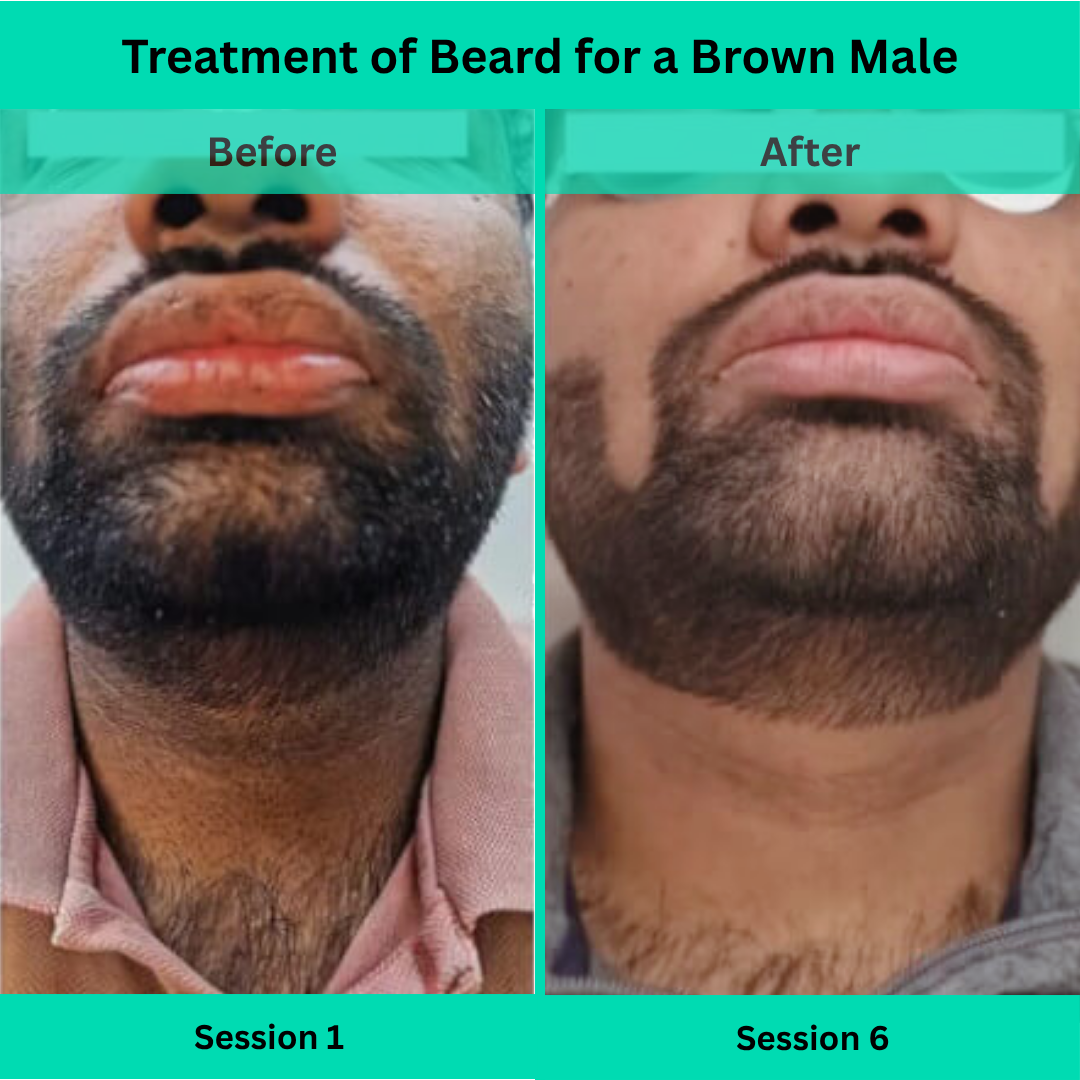 Before and After picture of Laser Hair Removal Treatment of Beard for a Male
